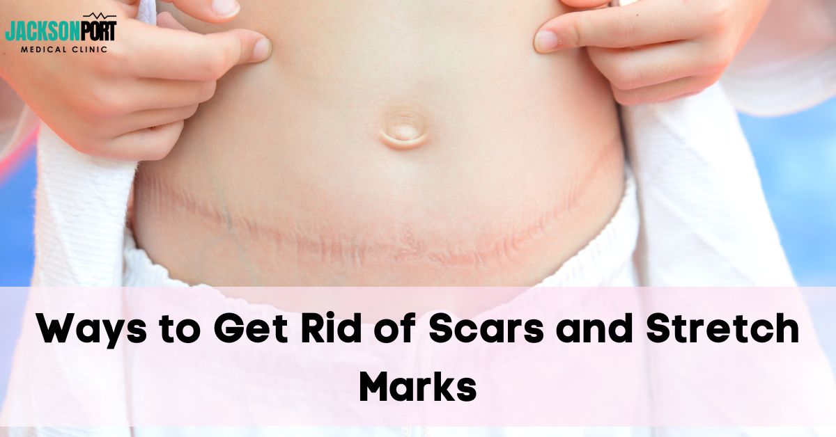 how to get rid of stretch marks